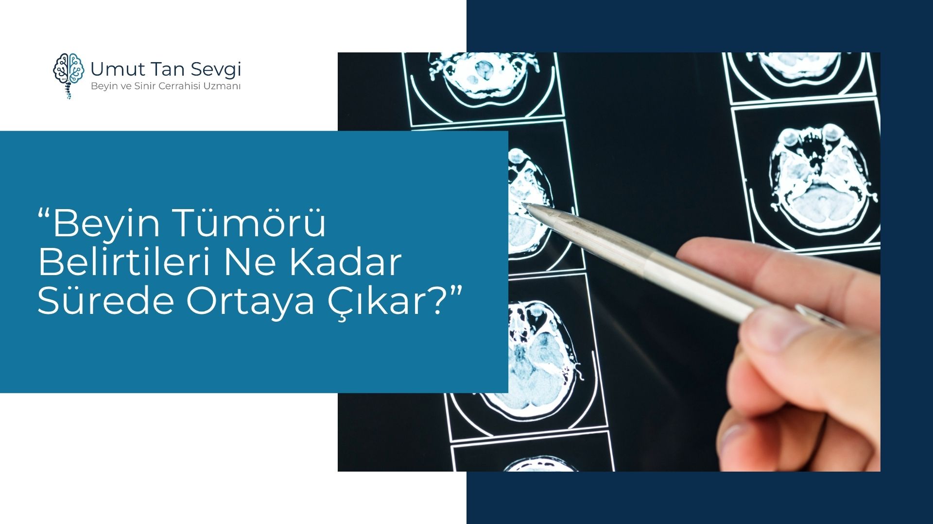 Beyin Tümörü Belirtileri Ne Kadar Sürede Ortaya Çıkar?