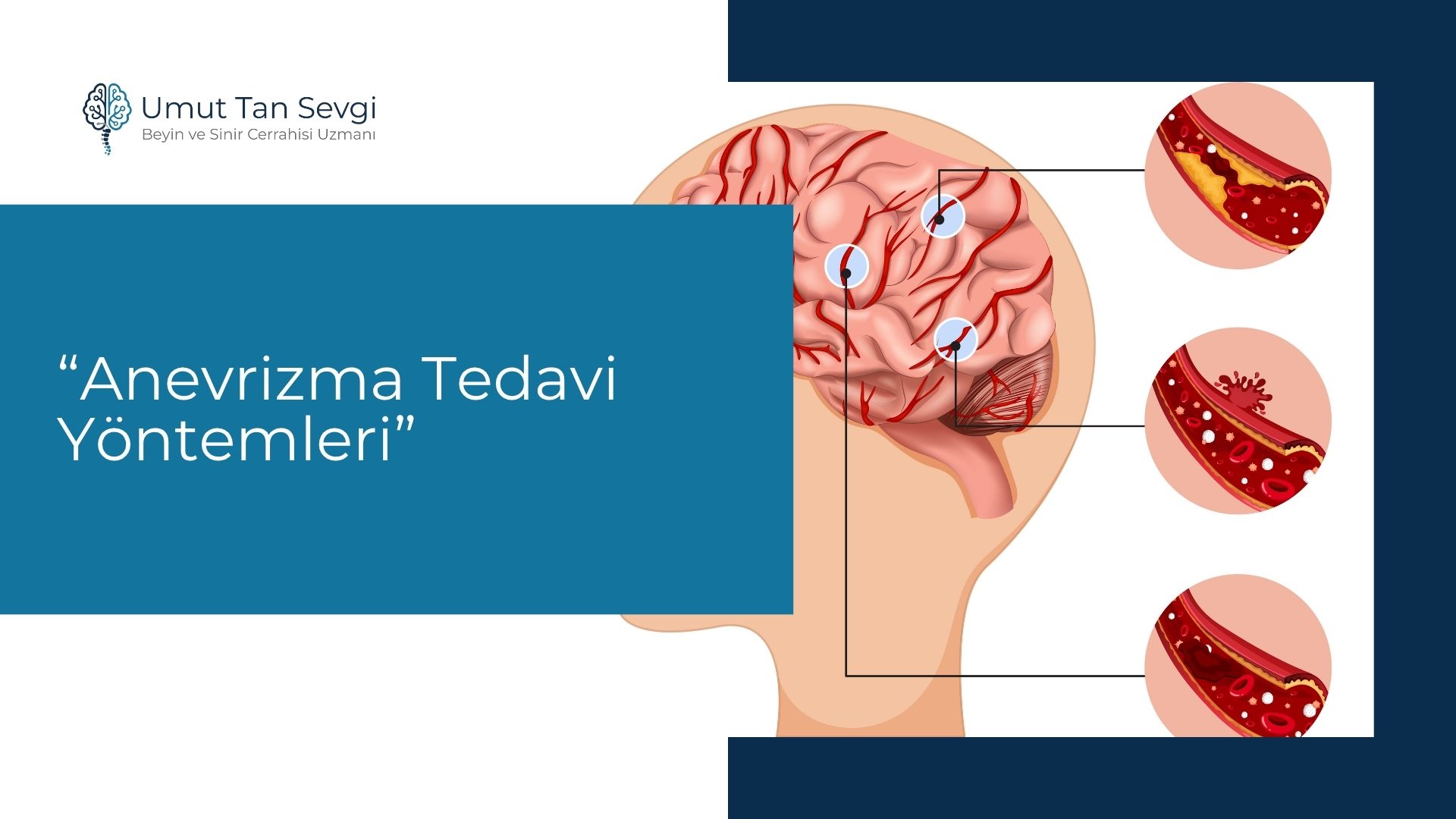 Anevrizma Tedavi Yöntemleri