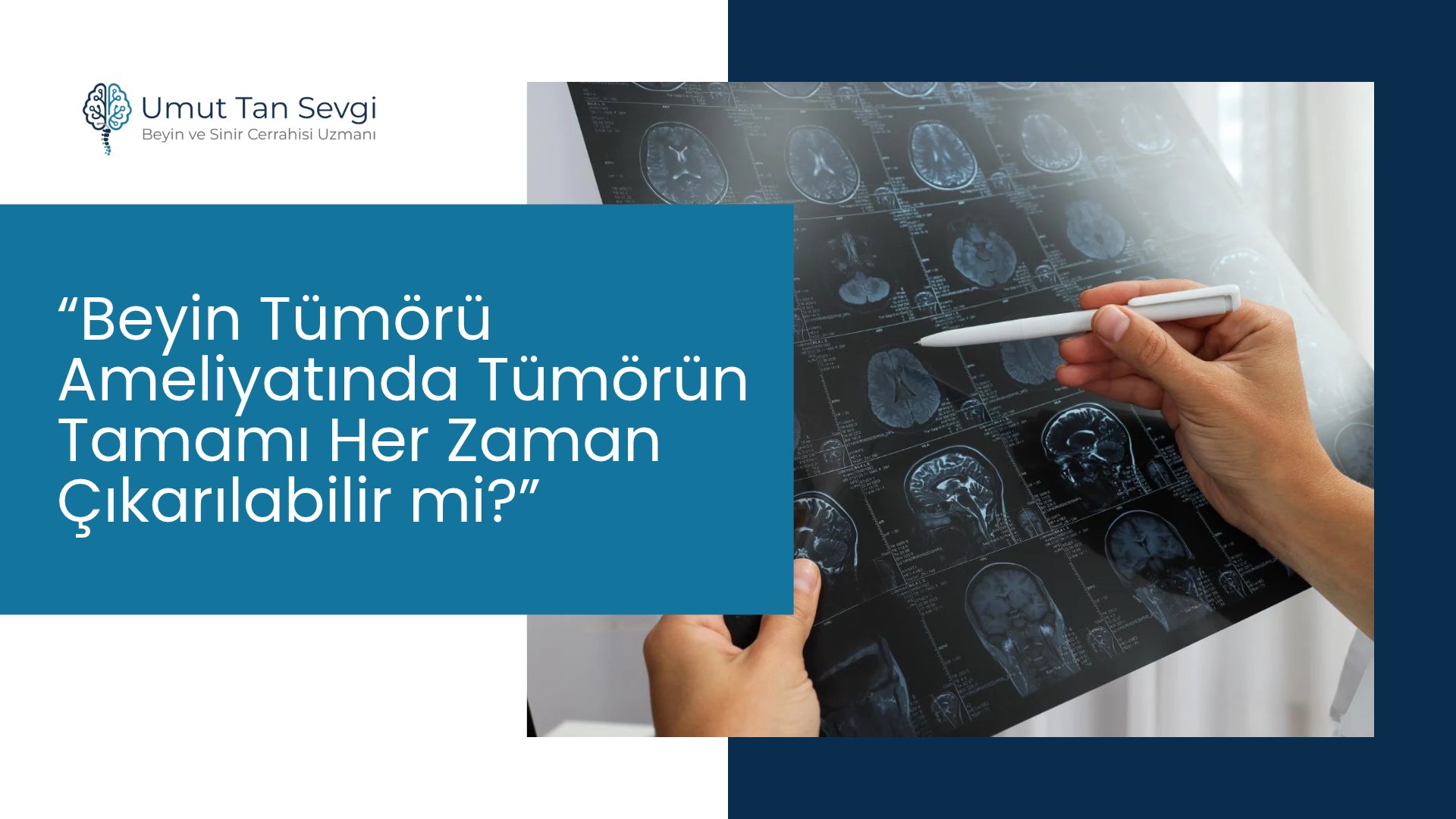 Beyin Tümörü Ameliyatında Tümörün Tamamı Her Zaman Çıkarılabilir mi?