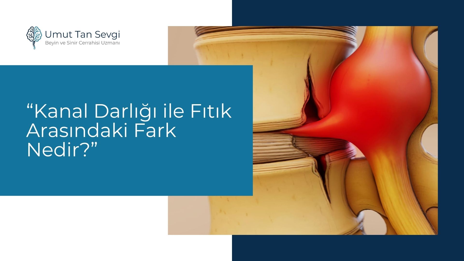 Kanal Darlığı ile Fıtık Arasındaki Fark Nedir?